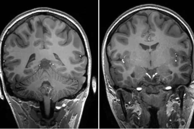 A 7 Tesla MRI of a human brain. Picture. 